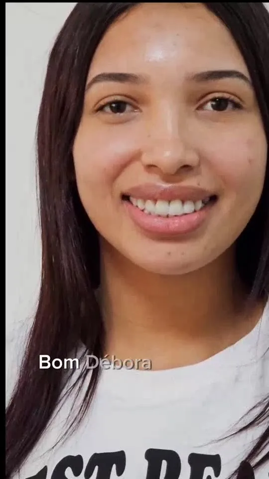 Facetas e estética