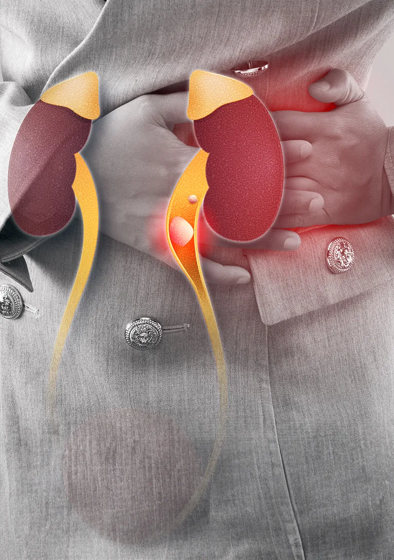 DIAGNÓSTICO DE CÁLCULO RENAL